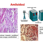 Amiloidosi: cause, sintomi e rischi di una patologia fortemente invalidante.